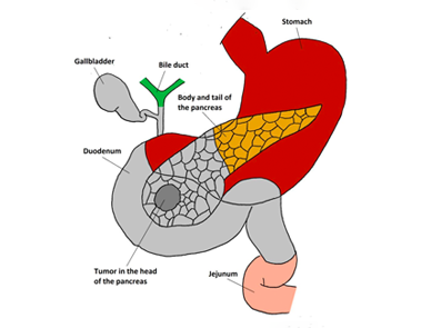 Lees meer over de pancreasanastomose: reconstructie met de maag of de darm?