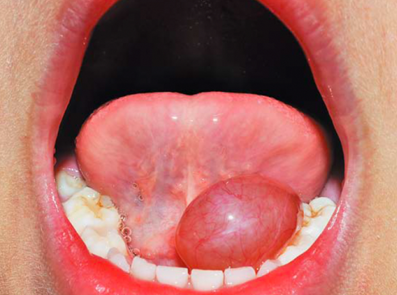 Dr. B.M. Wensing over Het kikkergezwel (ranula)