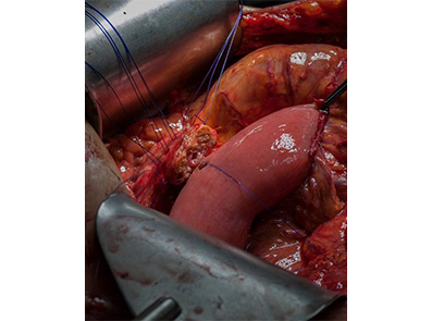 Eerste video robot-geassisteerde anastomose online