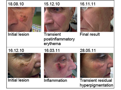 Dermatoloog Tim van Meurs over de verschillende behandelmethoden van het Lentigo Maligna.